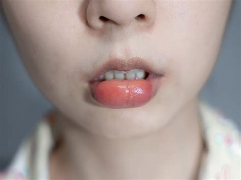 swollen lips from lip balm.